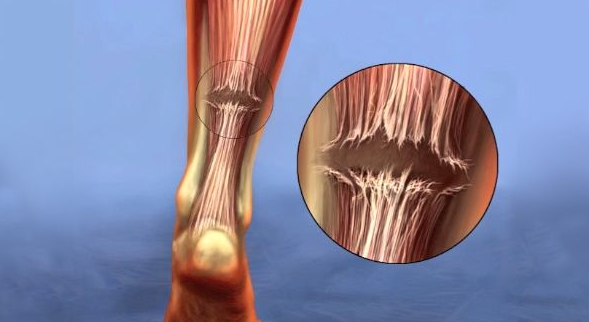 10 Minute Running Exercise and Protein Consumption Can Strengthen Achilles Tendon Threefold