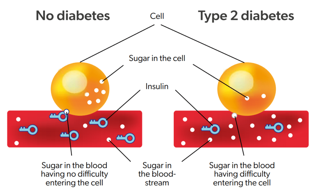 diabetes