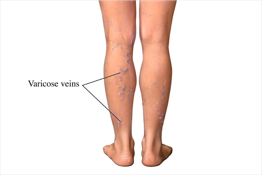 varicose veins