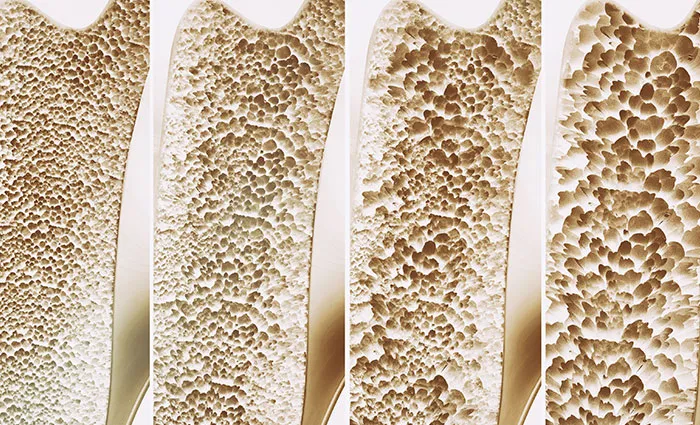 bone density